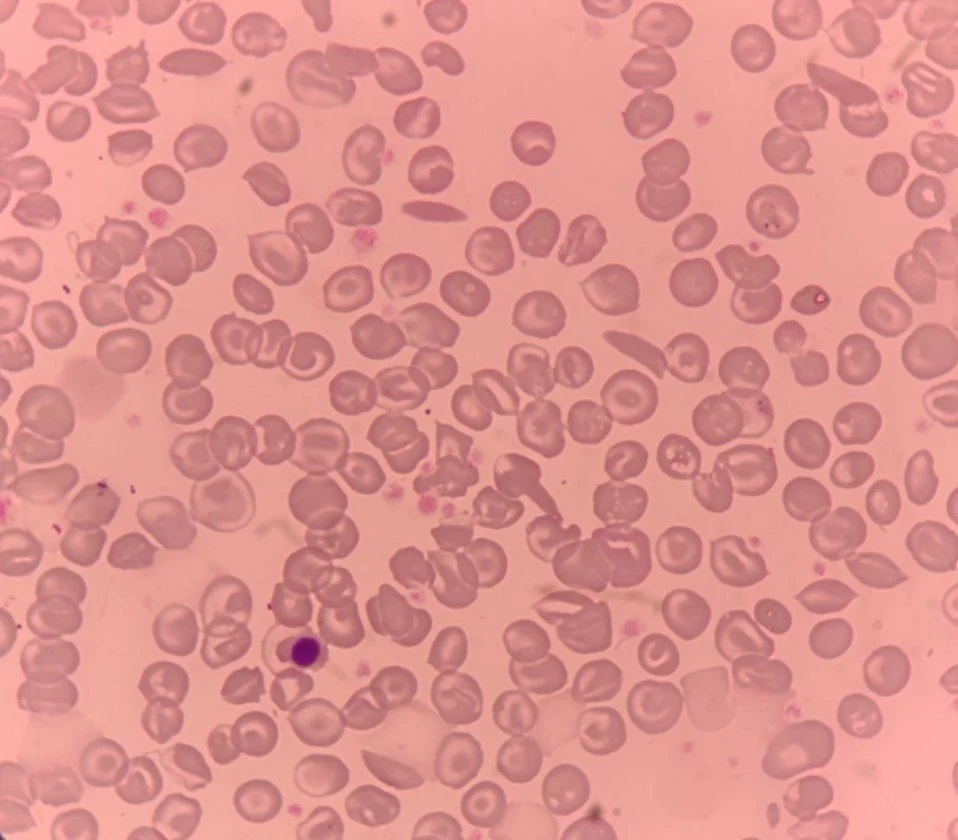 Maryam Alaa Alsaid: Diagnostic Puzzle of Sickle Beta Thalassemia 1 Maryam Alaa Alsaid: Diagnostic Puzzle of Sickle Beta Thalassemia