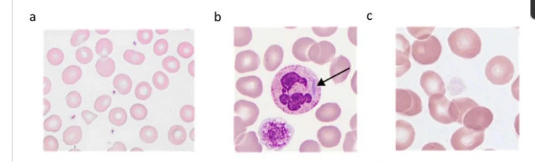 Sally Mandour: Platelet Size And Shape Can Reveal The Diagnosis