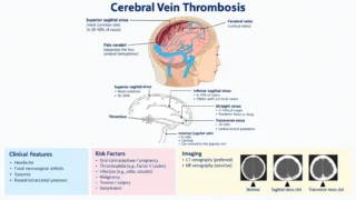 Sthanu Subramanian: Clinical Presentation, Risk Factors, Diagnosis, and Neuroimaging Findings in CVT