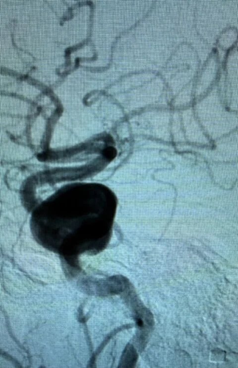 Fahad Laghari: Flow Diversion for a Cavernous Internal Carotid Artery Aneurysm