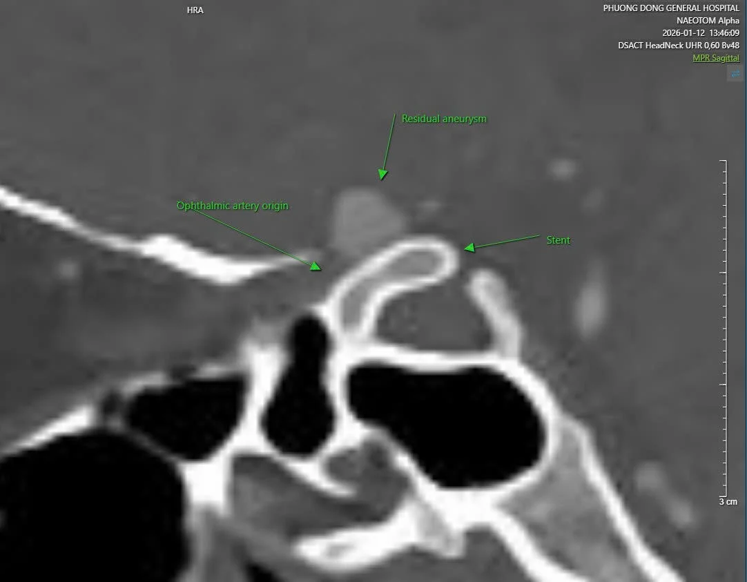 Giang Tran: Residual Internal Carotid Artery Aneurysm After Flow-Diverter Stenting