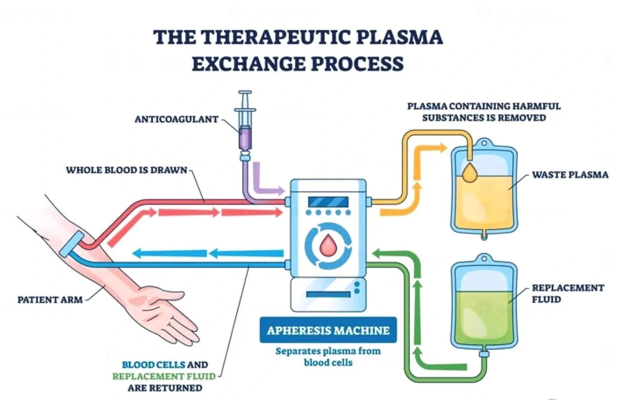 Sumyea Kabir: Optimizing Plasma Selection for Therapeutic Plasma Exchange in TTP