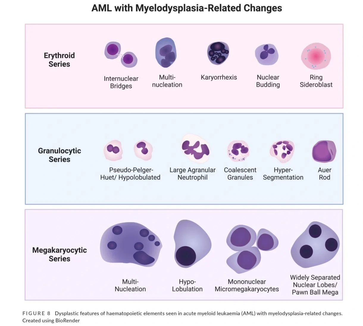 Anjali Pandey: The Morphologic Clues to MDS With del(5q) 1 Anjali Pandey: The Morphologic Clues to MDS With del(5q)