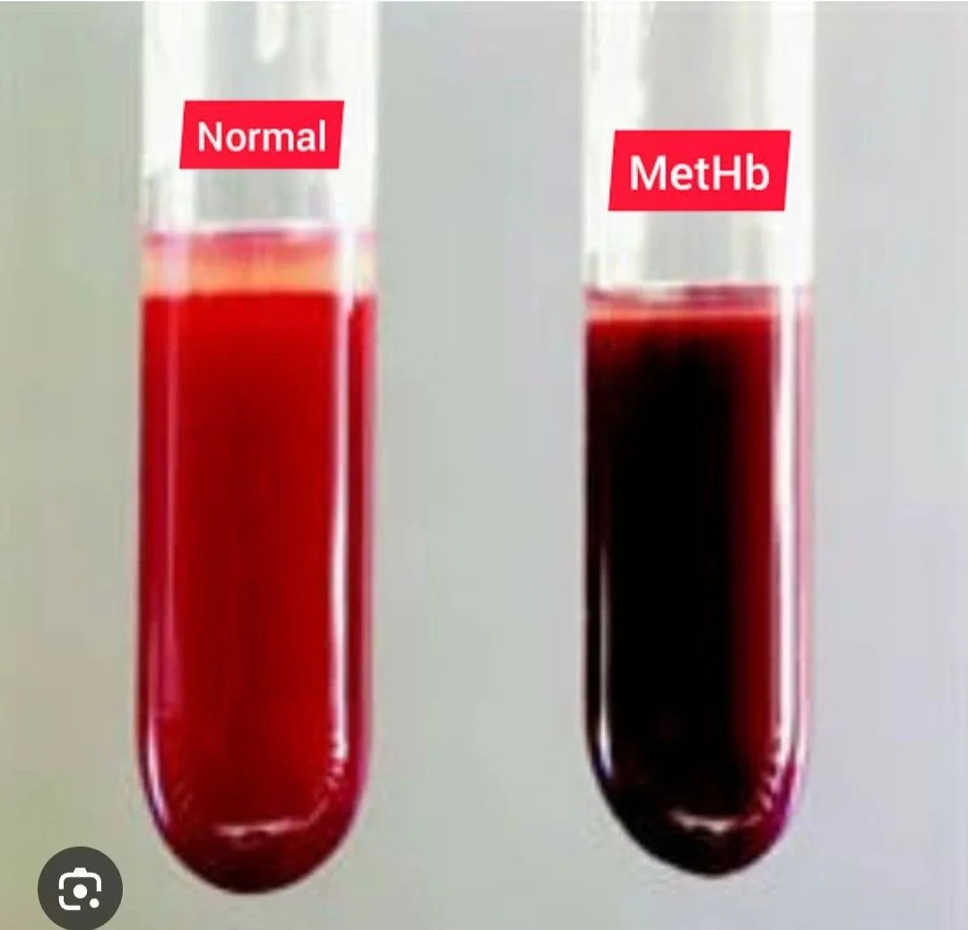 Sally Mandour: Methemoglobinemia When Hemoglobin Cannot Carry Oxygen