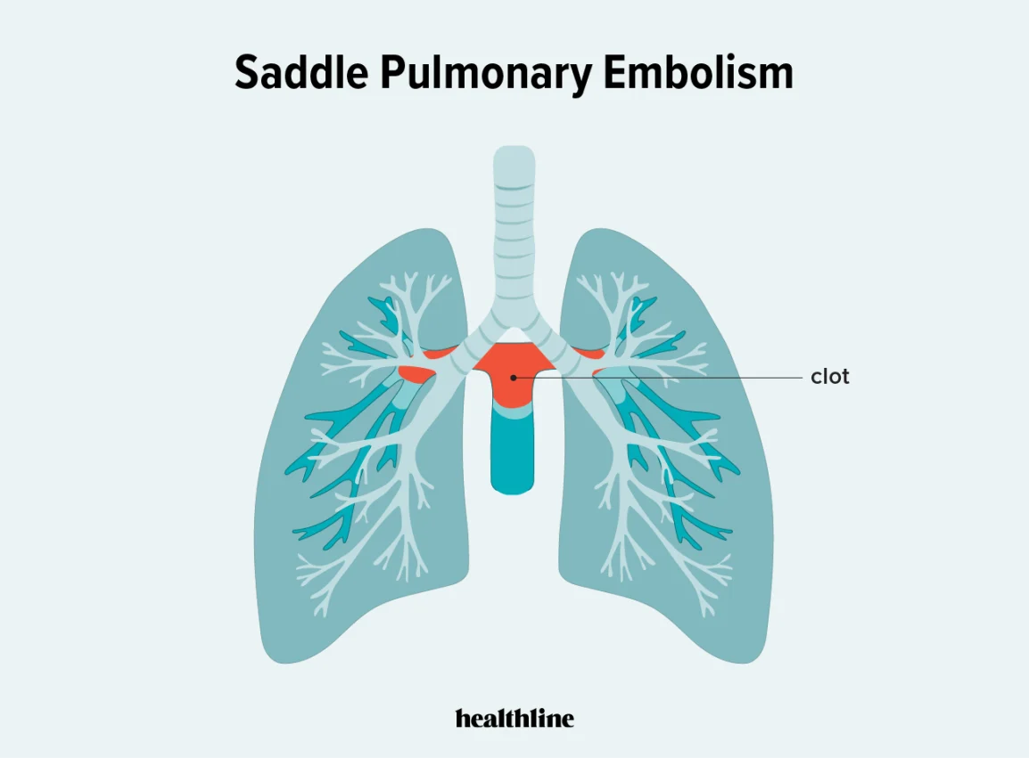 Basem Goueli: Blood Clots in the NFL 3 Basem Goueli: Blood Clots in the NFL