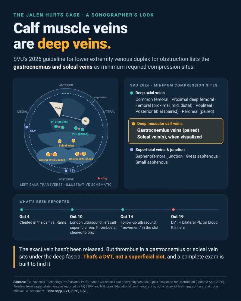 Brian Sapp: Why Exact Calf Vein Naming Is Critical for DVT Diagnosis? 1 Brian Sapp