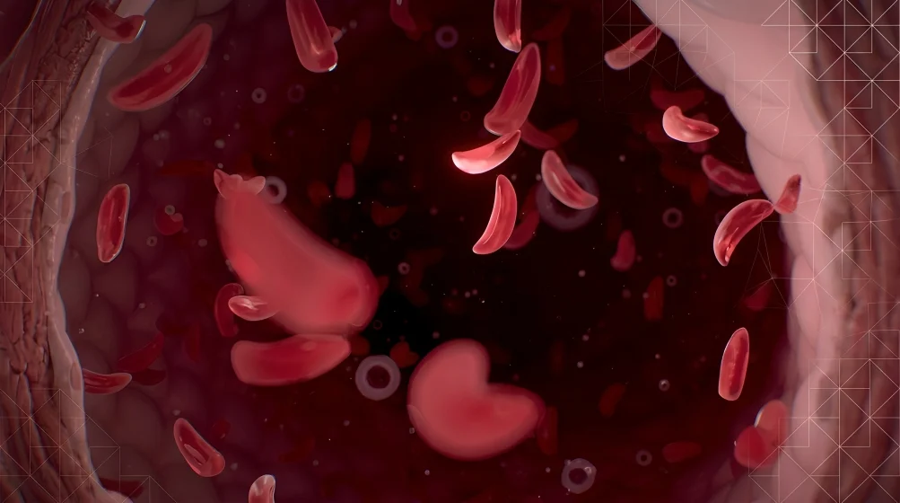 Donna Morelli: Hydroxyurea Safe and Effective for Pediatric Sickle Cell in Africa