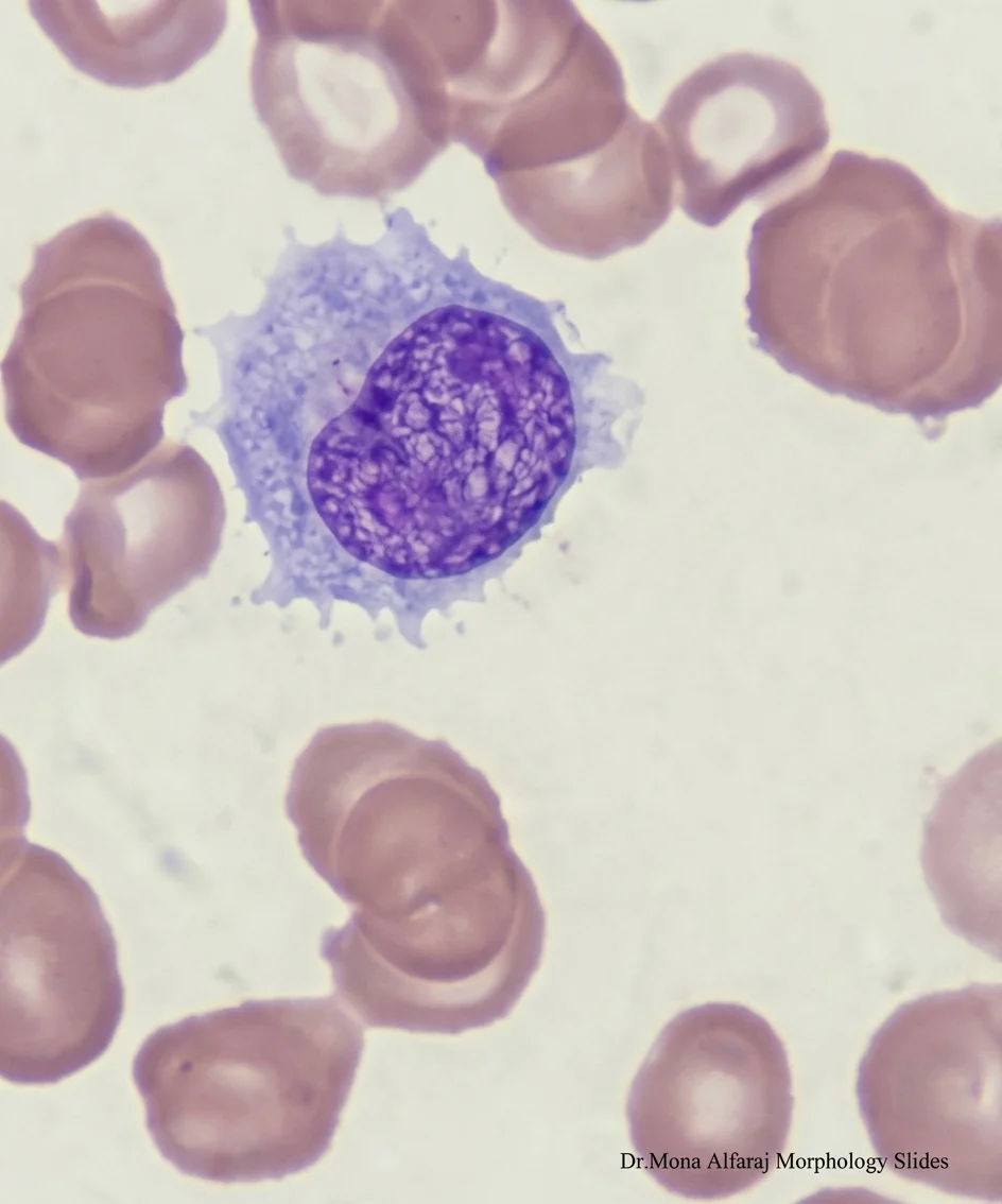 Mona Alfaraj: Distinguishing HCL from SMZL in Bone Marrow 1 Mona Alfaraj: Distinguishing HCL from SMZL in Bone Marrow