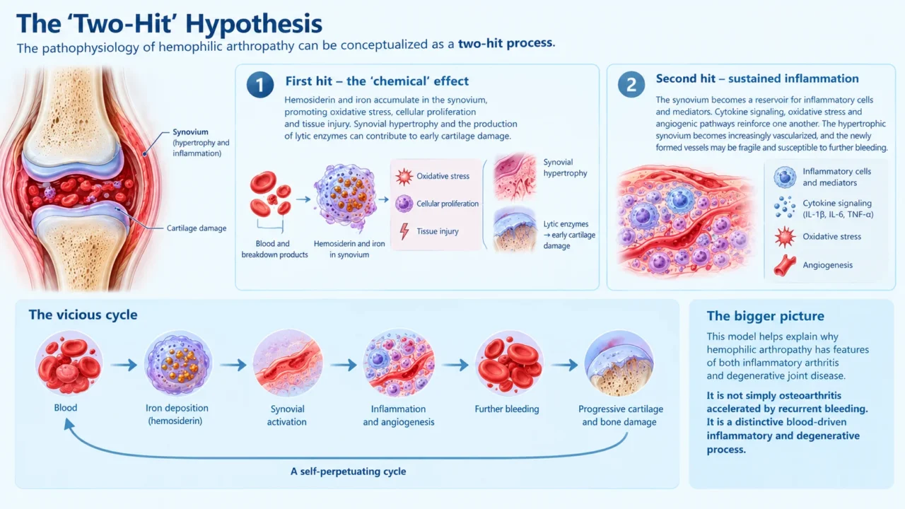 Blood-Induced Joint Damage in Hemophilia: Beyond Recurrent Hemarthrosis