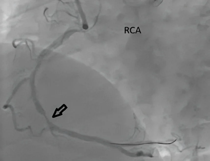 Irma Bagdoniene: Multidisciplinary Management of High-Risk Familial Hypercholesterolaemia and CAD